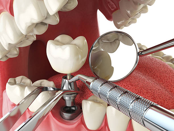 Best Emergency Dentist for Lost Fillings or Crowns in Antwerp, OH